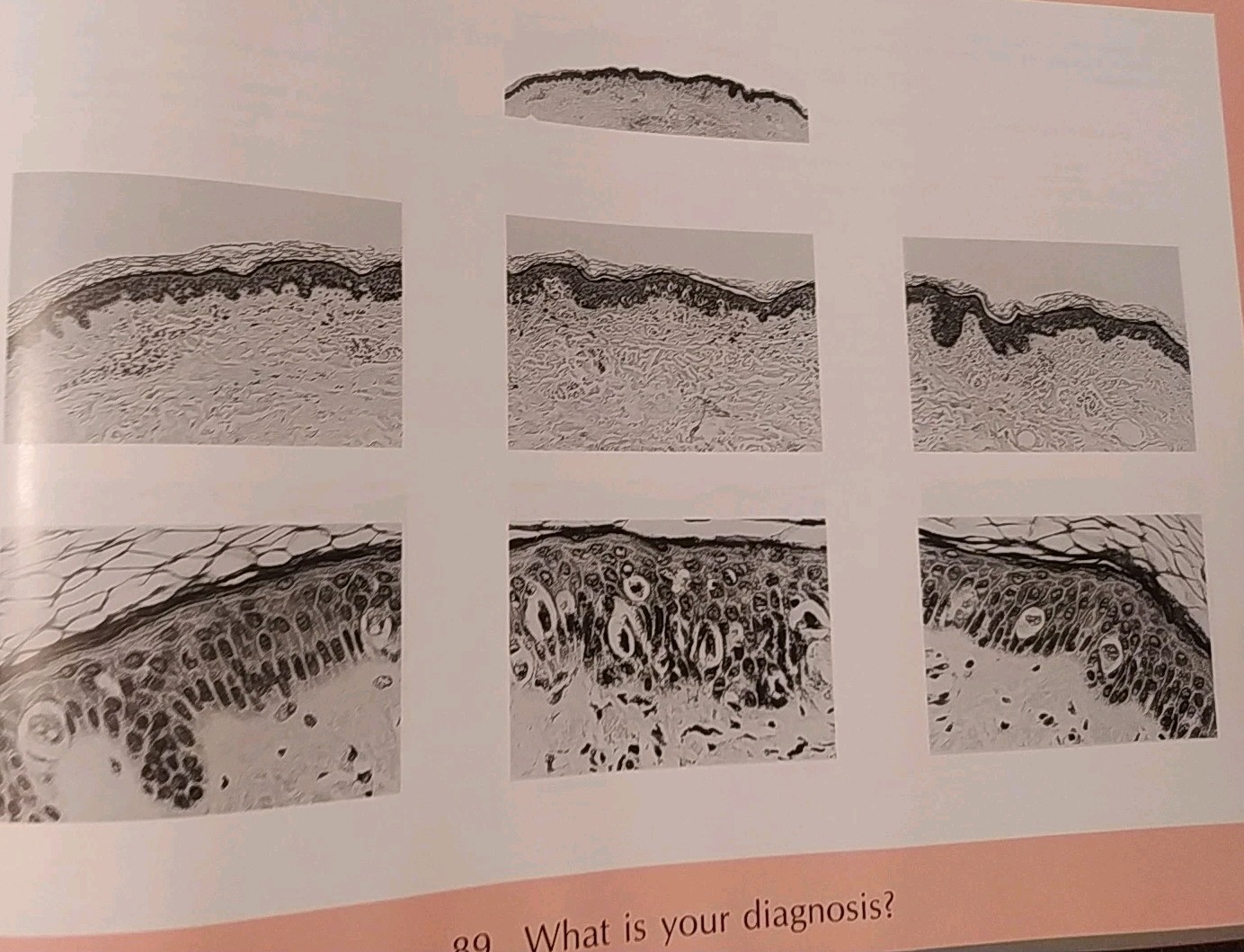 Pitfalls in Histopathologic Diagnosis of Malignant Melanoma A B Ackerman