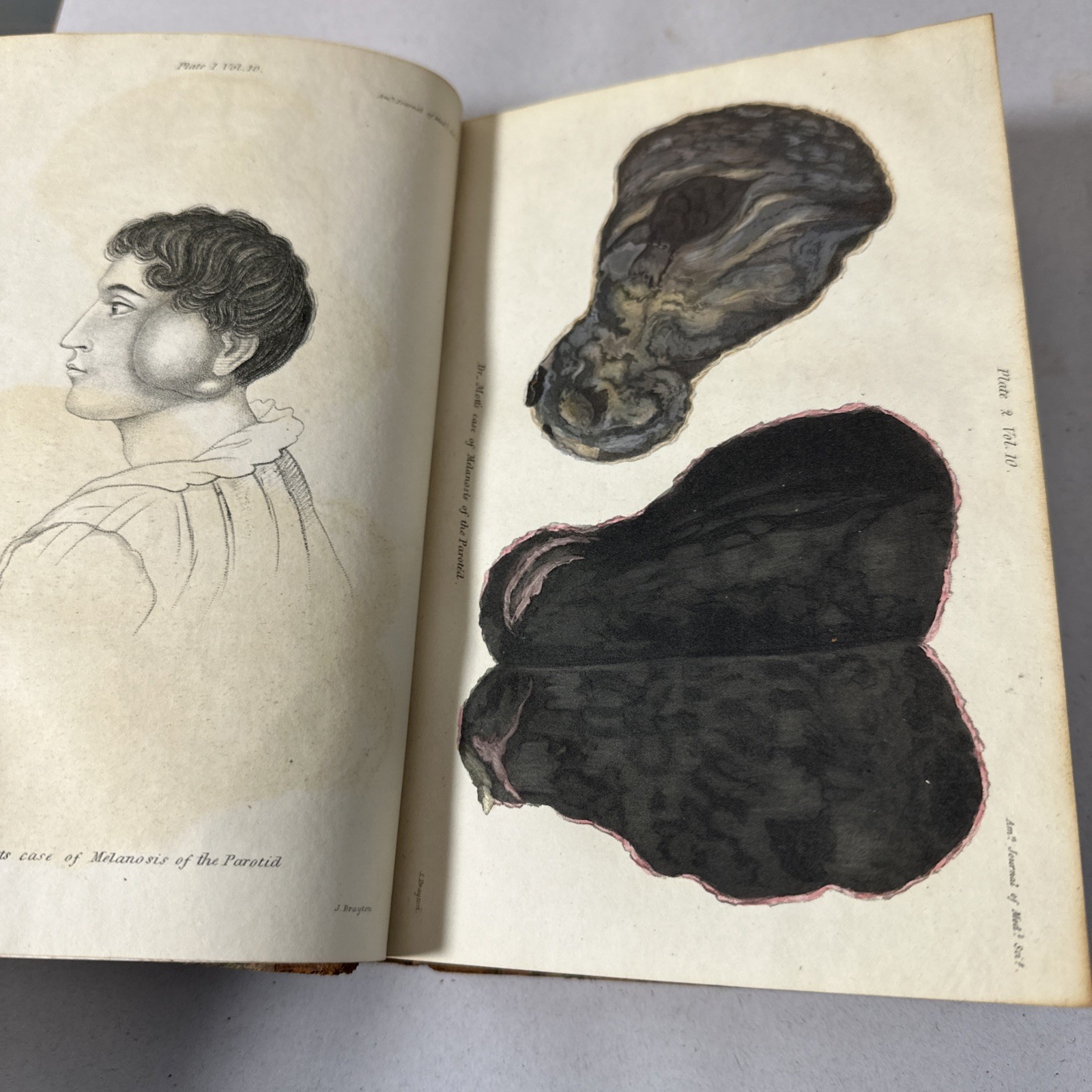 American Journal Medical Sciences 1832 First Edition Book Plates Volume 10