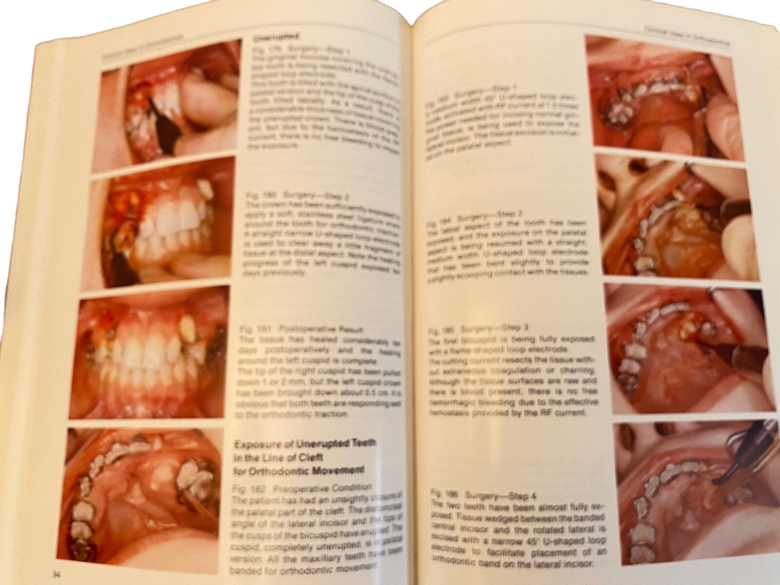 Color Atlas of Oral Electrosurgery Maurice J Oringer Hardback 250 Pages 1984
