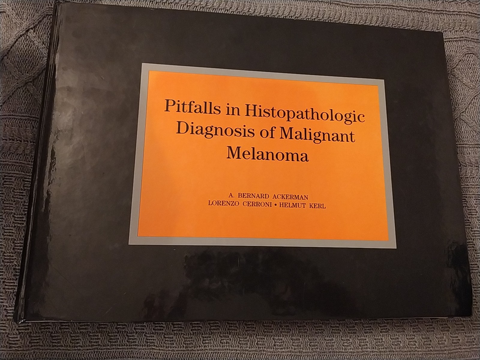 Pitfalls in Histopathologic Diagnosis of Malignant Melanoma A B Ackerman