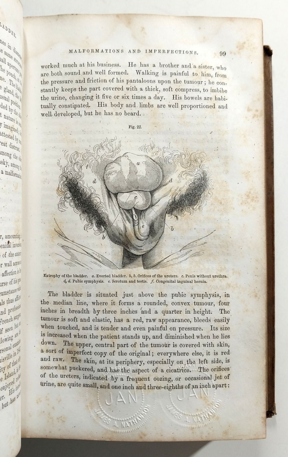 A Practical Treatise Diseases Injuries Urinary Bladder Prostate Gross 1851 HC